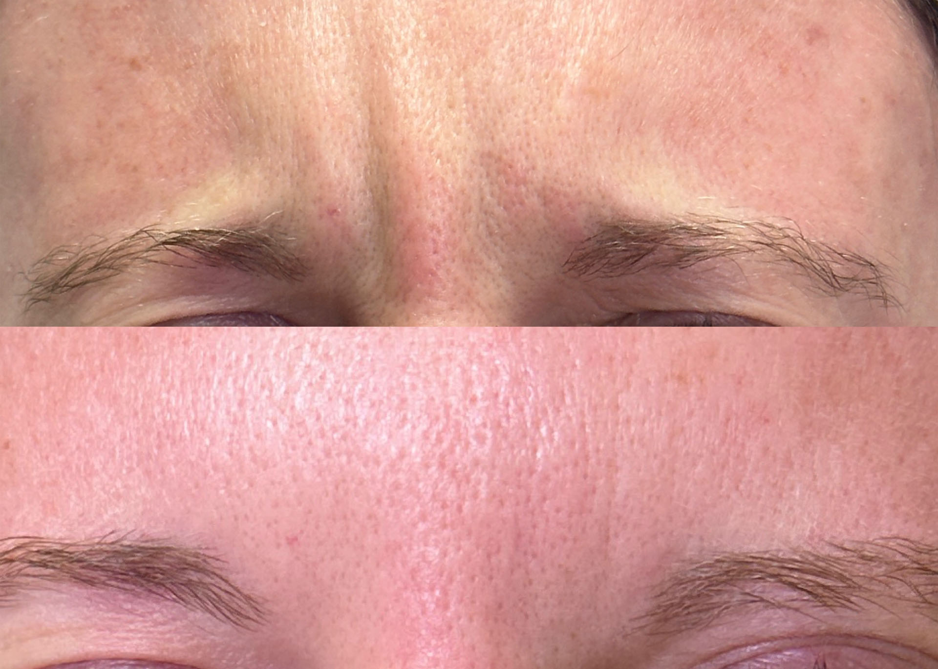 First 20 units of Botox: $179