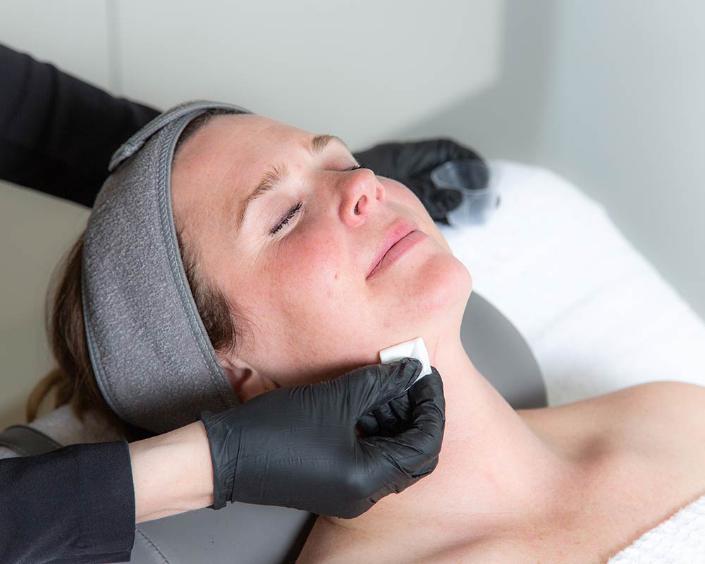 Painless Chemical Peel in Cherry Hills
