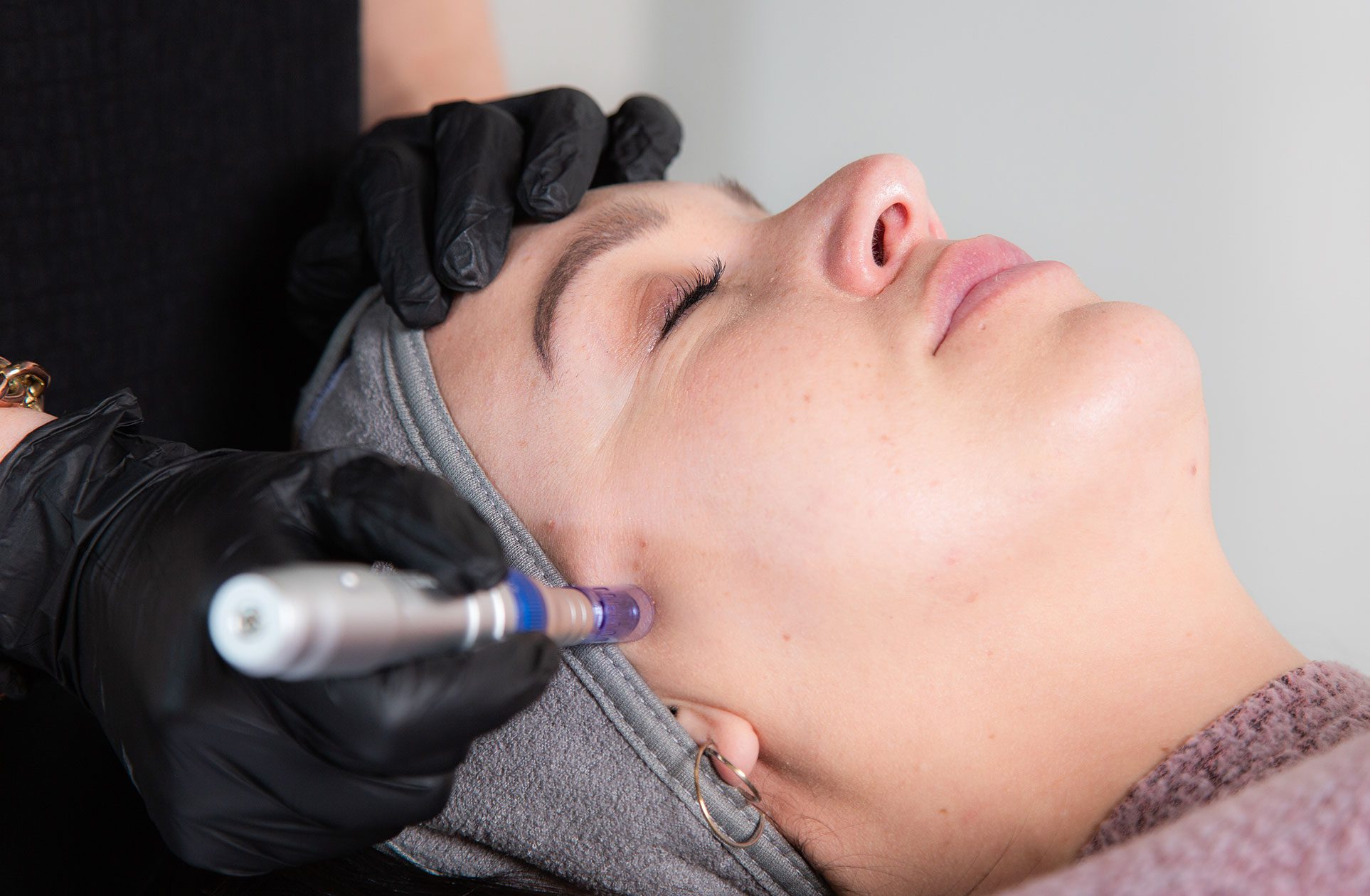 Microneedling