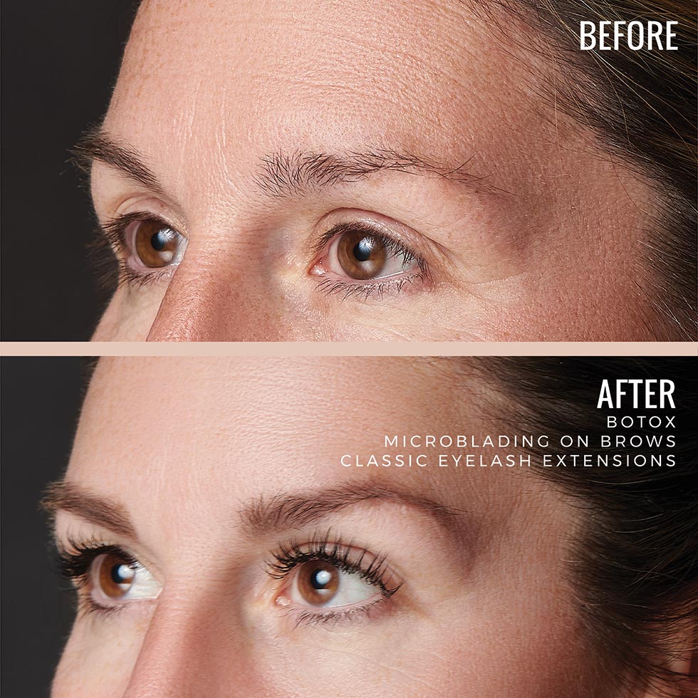 Before and After Botox Microblading Treatment Images