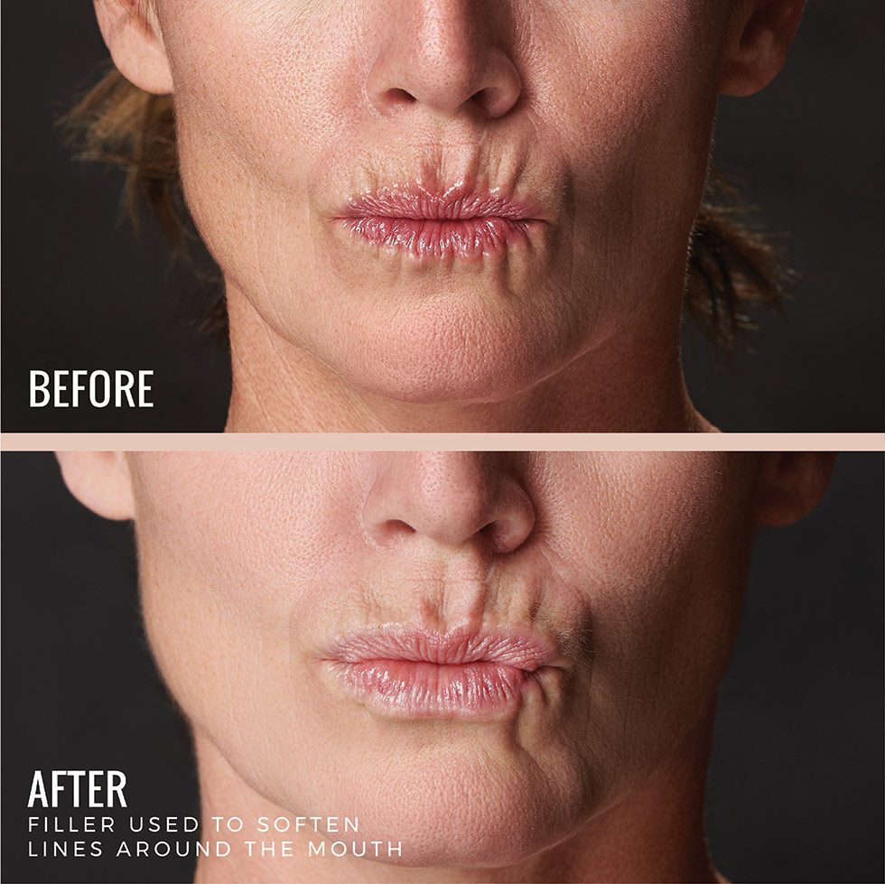 Fillers Before and After